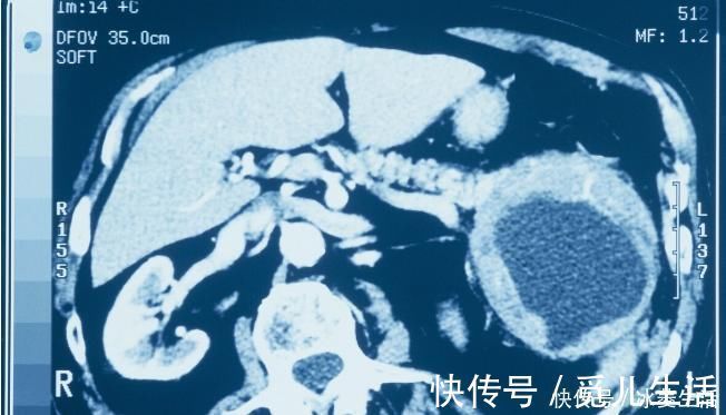 进展期|癌症并非是绝症，做好这一点，癌症晚期患者延长12年生存期