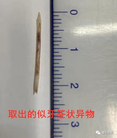 十二指肠|六旬婆婆突然反复高热、寒颤！只因这个饮食习惯，医生紧急提醒