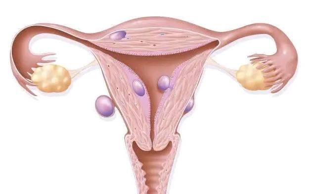  易得|5种女人最易得子宫肌瘤！中医2妙方活血化瘀、除寒湿，和肌瘤拜拜