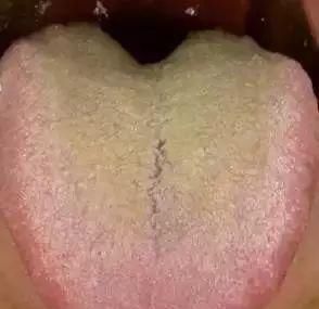  果你|免疫力是长寿关键，到底该如何加强自己免疫力？你的舌头知道答案