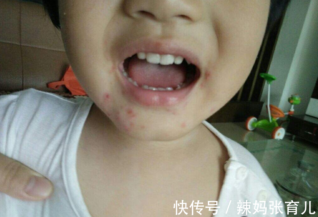 宝宝|原本以为夏季才是手足口病的高发期,没想到冬季也是