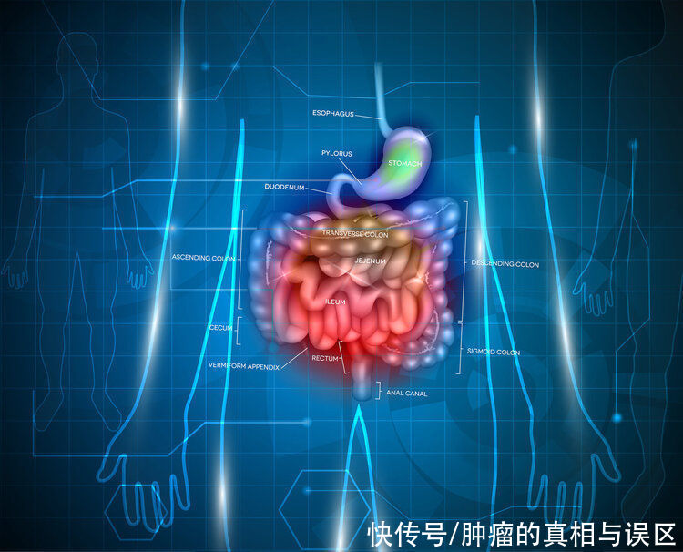 复发|肠息肉为何切了又长？医生提醒：不想复发，术后一个行为很关键