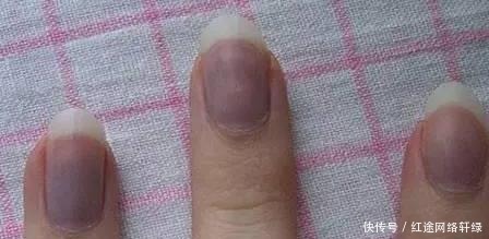 求救|身上4处发黑,说明肝脏在“求救”,多吃补肝水果,预防肝病