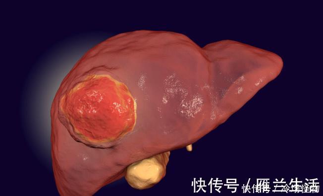 病人|什么是“帶瘤生存”這名15公分巨大型肝癌患者是如何實現的
