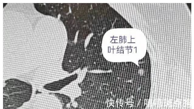 结节|磨玻璃肺癌都是高分化腺癌吗?磨玻璃结节发展到哪种腺癌都有可能