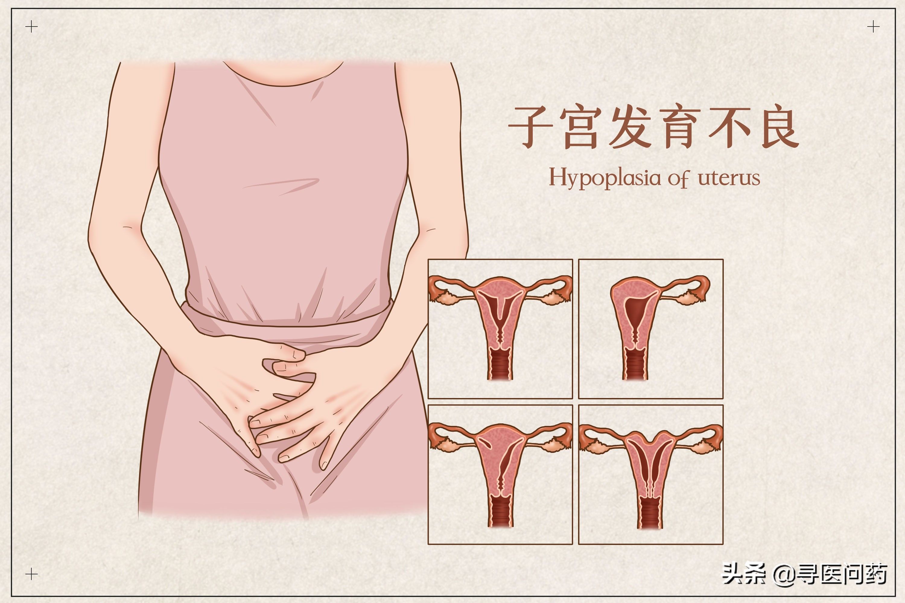 输卵管|月经不规律，结果查出有两套生殖器，双子宫双阴道