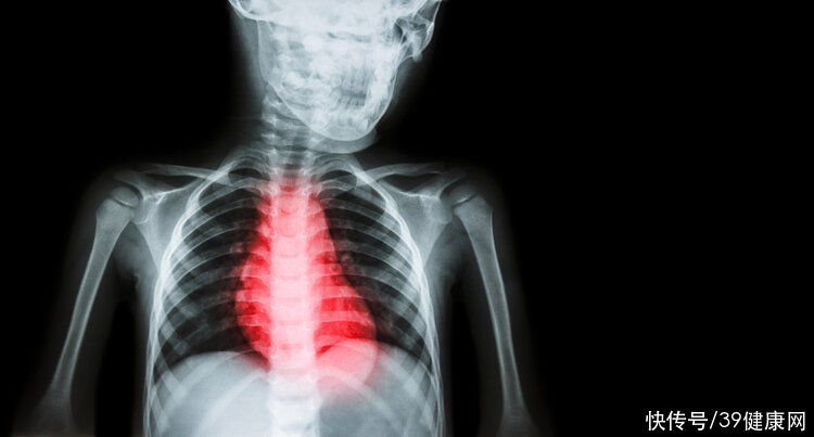 深静脉血栓|21岁突发心梗，医生掏出10块血栓！提醒：血栓喜欢“吃”3种食物