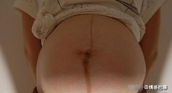 孕妇肚脐中间有条黑线,为啥有的笔直一条,有的却偏左或偏右?