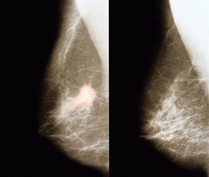 乳房|80%的人都不知道,早期乳腺病自己就能发现!济南中科甲乳医院