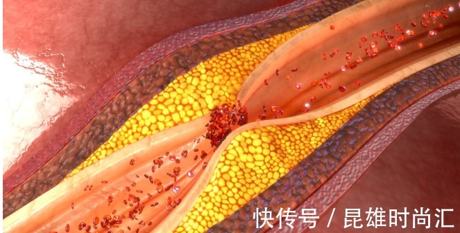 胆固醇|高血脂是吃出来的?坚持“两低一高”饮食,2个月轻松吃掉高血脂