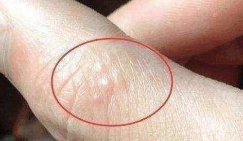  手脚|手脚长出许多“小水泡”，一抓还很痒是为何？一文全部解释清楚