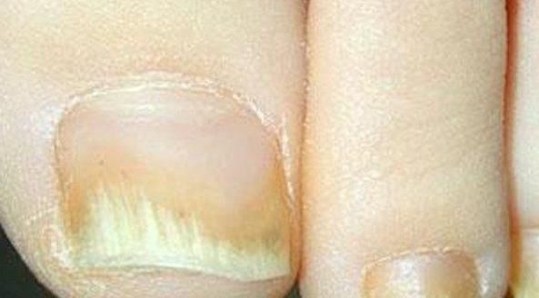 检查|指甲如果长成5种样子,说明你的身体状况不是太好,需要检查了
