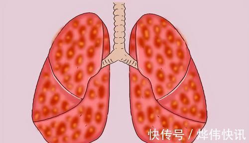 肺癌|医生坦言：最不希望患者碰到3种癌，发作前毫无征兆，要早作预防
