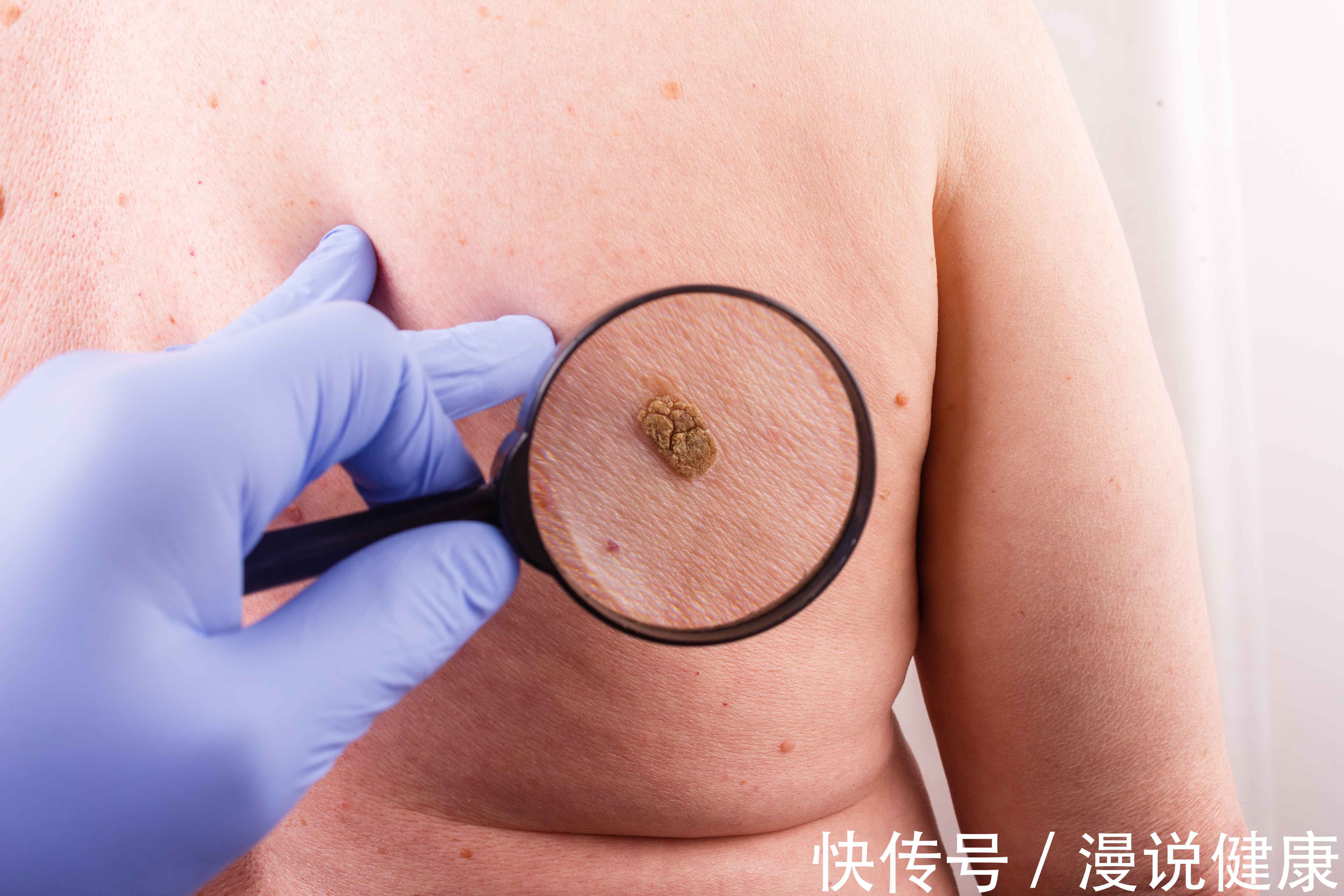 斑点|皮肤也会长癌?皮肤出现这4种现象,小心是皮肤癌来“报道”!
