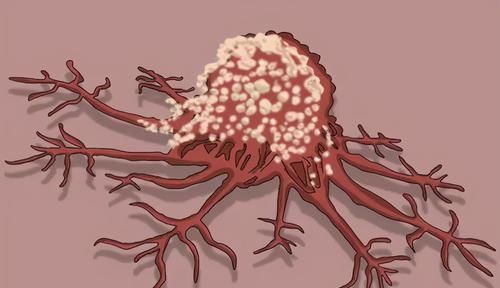 医生|得了癌症,不治疗会如何?医生提醒:3个后果可能会找上门