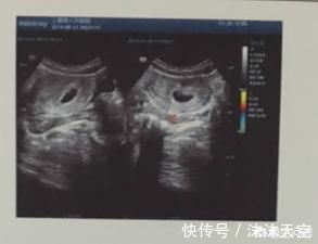 胚胎|为什么怀孕不到3个月,医生还让我做B超检查,有什么意义?