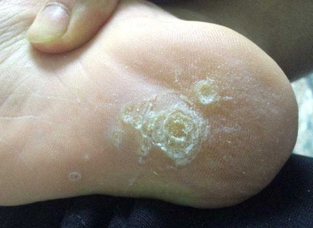 炎症|无论男女身体3个地方长疙瘩,可能不是炎症或过敏,而是HPV