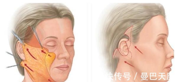 拉皮 51岁小拉皮术后1个月，我想跟大家说点真心话