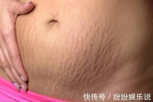 妊娠纹|爱美的孕妈注意了,原来妊娠纹也是挑人的,这几类孕妈需要注意了