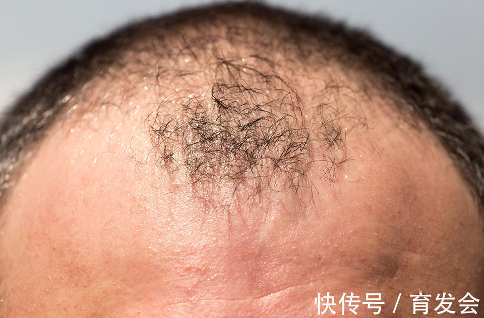 发际线 植发后头发还会脱吗?一般能维持多久?