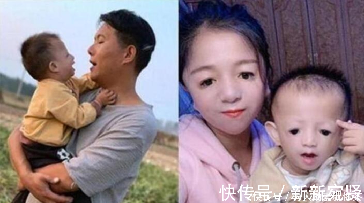 遗传性|“鸟脸”妈妈执意生“二胎”,产下孩子容貌引争议,如今后悔了!