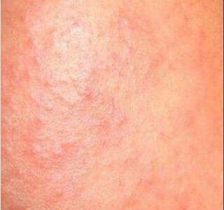 皮肤过敏|皮肤都很脆弱,过敏说来就来,远离它注意以下几点!