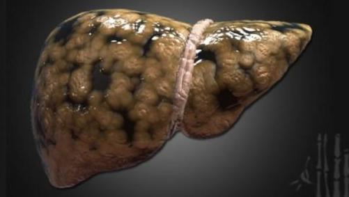 肝细胞|黄豆是肝病的发物,医生提醒,想要肝脏好,3种食物劝你少吃