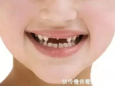 乳牙|家长必读权威专家提醒：必须在12岁前处理的10种儿童牙颌畸形