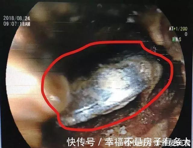 毒物|小小一枚,孩子喉管被腐蚀!再说一遍,这些东西必须放好了