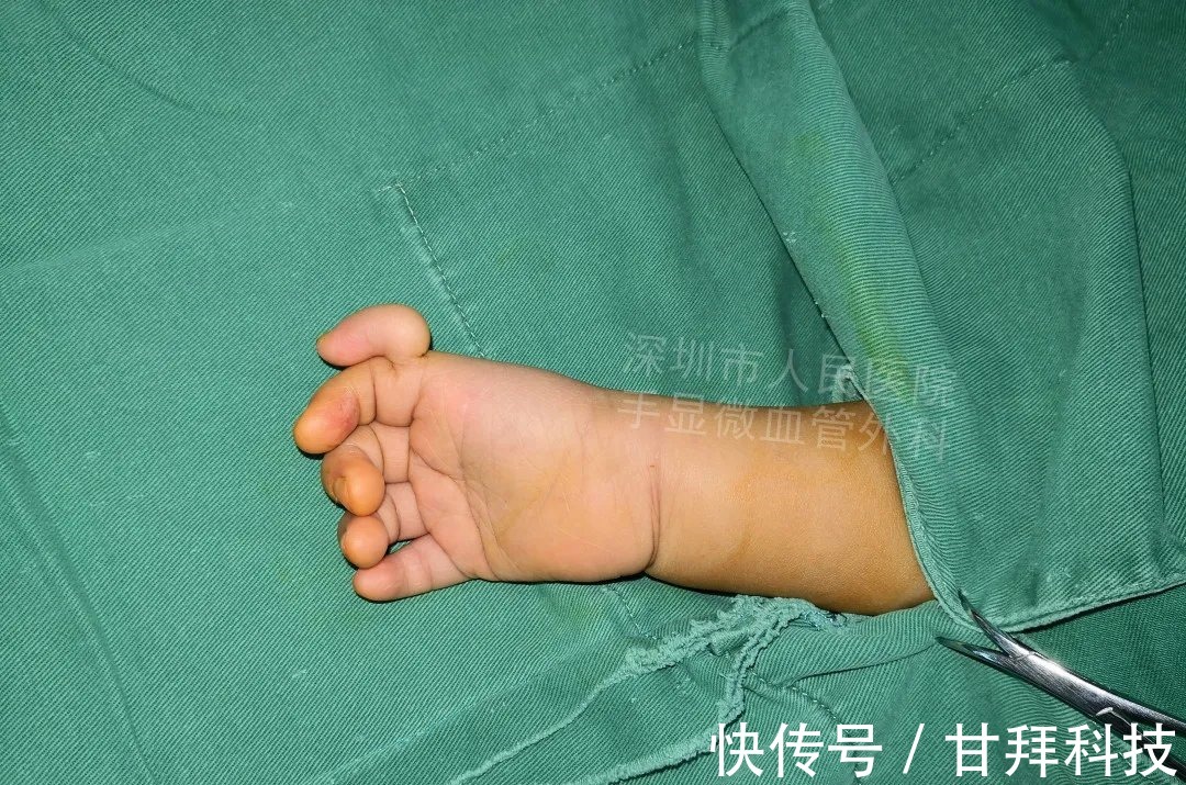 男孩|得了这病,12岁男孩手指比香蕉还粗!7种常见的手部畸形,家长们要注意