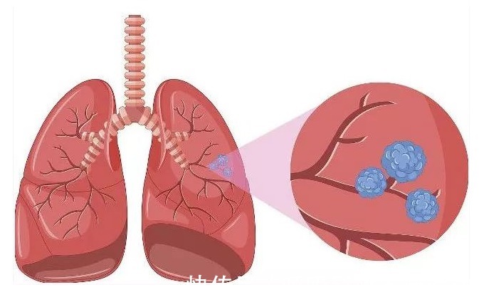 肺结节能|肺结节能彻底治愈吗