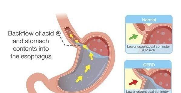 检查胃病,除了做胃镜检查,还有以下几种检查方式!早知早受益