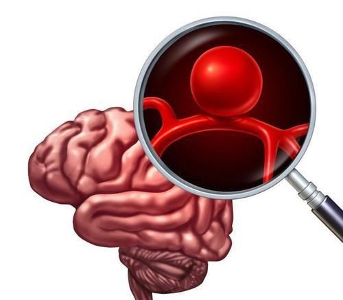 50岁后，“面部”出现3个异常，可能是脑出血要发生，希望你没有