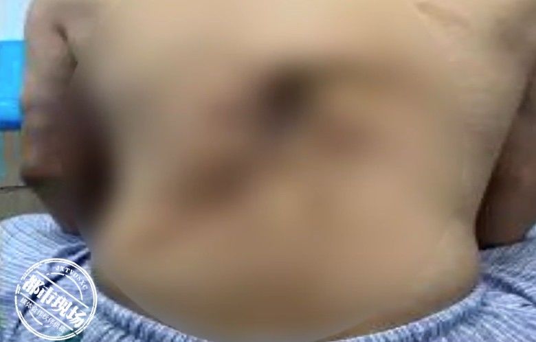 伤口|男子身上小疙瘩变“大洞”