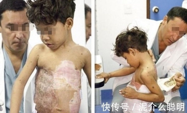 肉瘤|8岁男孩背上长“乌龟壳”,得知真相后,旁人感到心疼不已