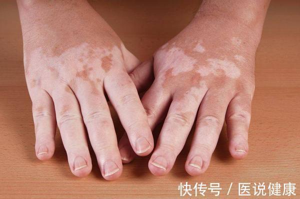 微量元素|白癜风患者,饮食要牢记这6个禁忌,防止加重病情,别忽视