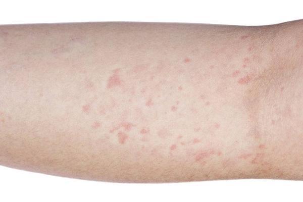 丘疹|当毛囊炎到来时,身体会出现4个表现,留意到一个,也要重视