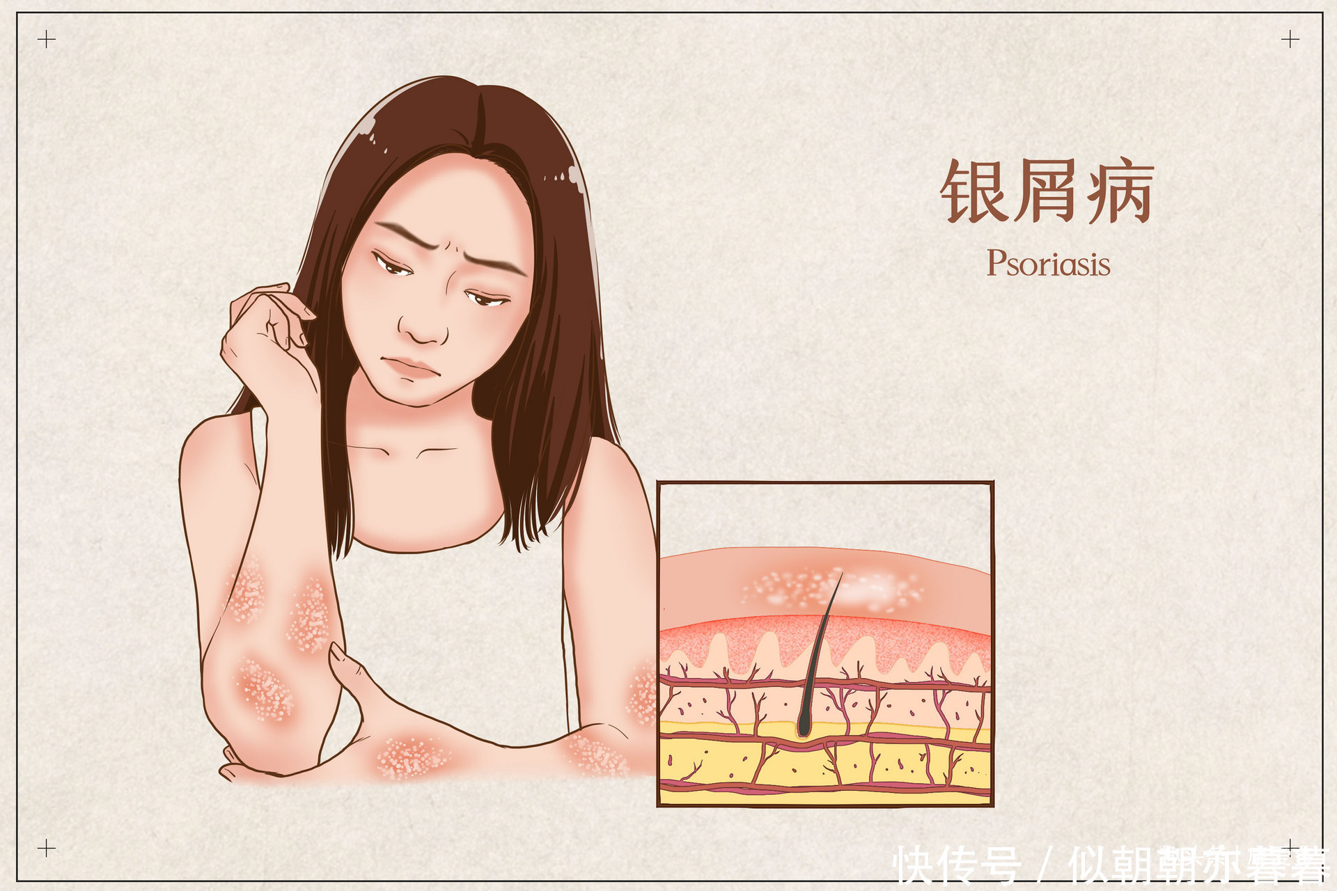 复发|冬季气温下降,皮肤变得干燥,银屑病患者症状复发,该怎么办