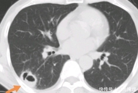 化疗|化疗会造成癌症扩散吗?