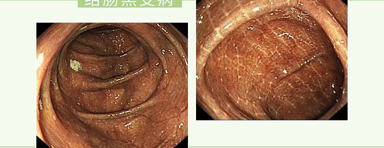 结肠黑变病|你今天大便了吗？