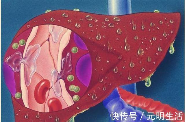 主治医生|22岁妹子罹患肝癌,医生建议肝移植,妹子思考良久:不做!