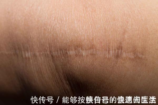 分娩|剖腹产真的比顺产轻松吗?产妇在3个时刻,会痛得咬牙