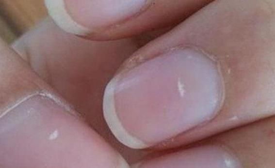 检查|指甲如果长成5种样子,说明你的身体状况不是太好,需要检查了