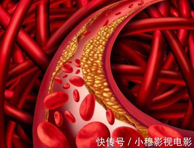 王大爷|57岁大叔,每天吃洋葱降血脂,一段时间后他的血脂有啥变化?