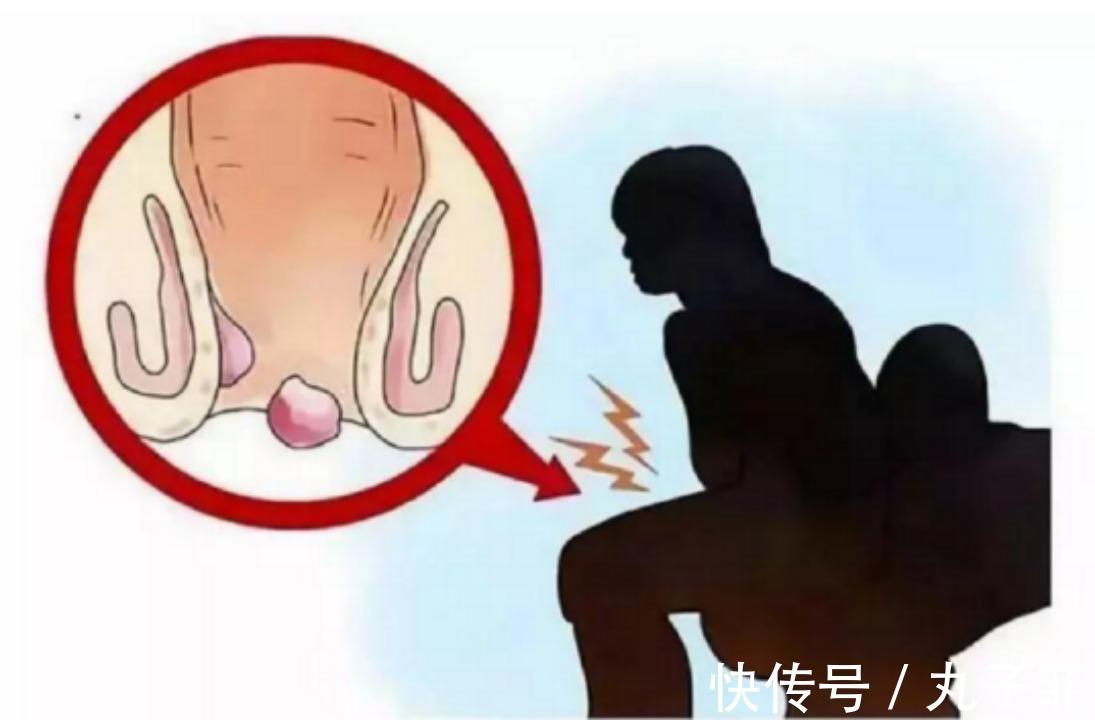 痔疮膏|痔疮权威大测评来了!这款痔疮特效药,我不允许你还不知道!
