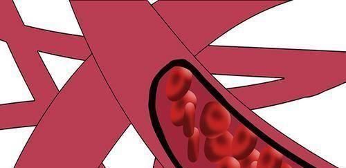 心脏放了支架后,还能活多久心脏支架有没有副作用