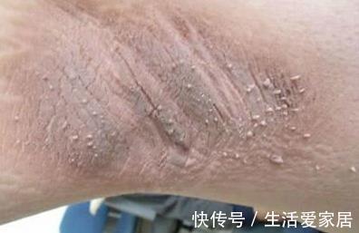 腋窝|胃癌刚发生时，腋窝最先有“异常”，可惜多数人视而不见