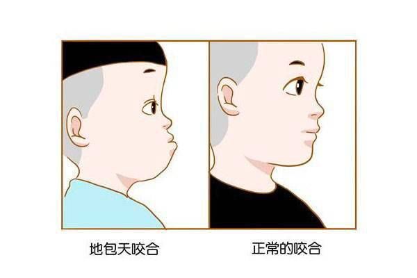 矫治|牙齿“地包天”？医生：从小预防很关键