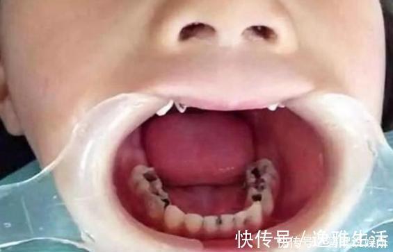 龋齿|四岁宝宝满口“黑牙”,罪魁祸首不是糖果,而是家长的放纵