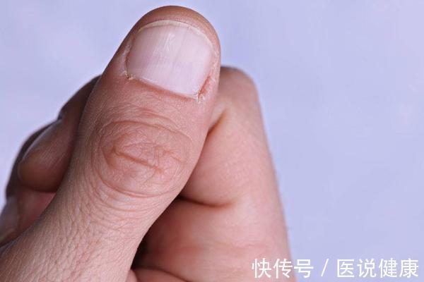 肝脏|肝不好,指甲知道!指甲若有6种表现,或是肝脏“病”了